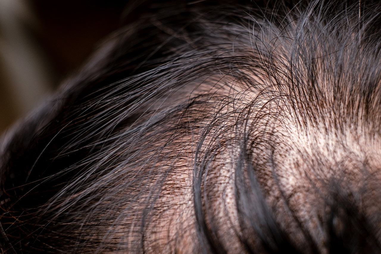 hair loss